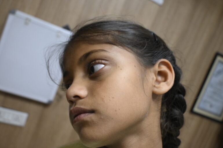 Flat warts for 4 years cured quickly with Homeopathy A case from Unnao