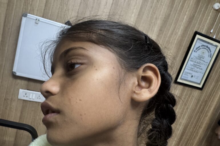 Flat warts for 4 years cured quickly with Homeopathy A case from Unnao