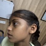 Flat warts for 4 years cured quickly with Homeopathy A case from Unnao