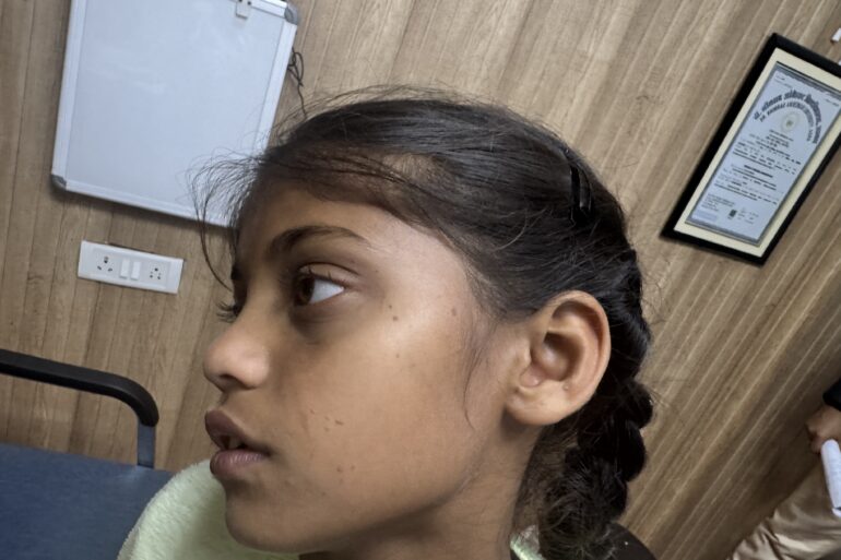 Flat warts for 4 years cured quickly with Homeopathy A case from Unnao