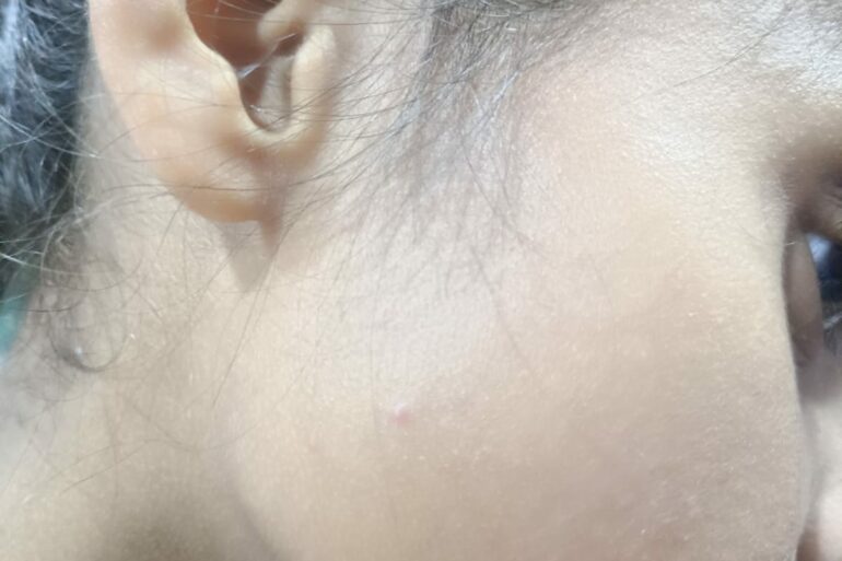 Flat warts for 4 years cured quickly with Homeopathy A case from Unnao