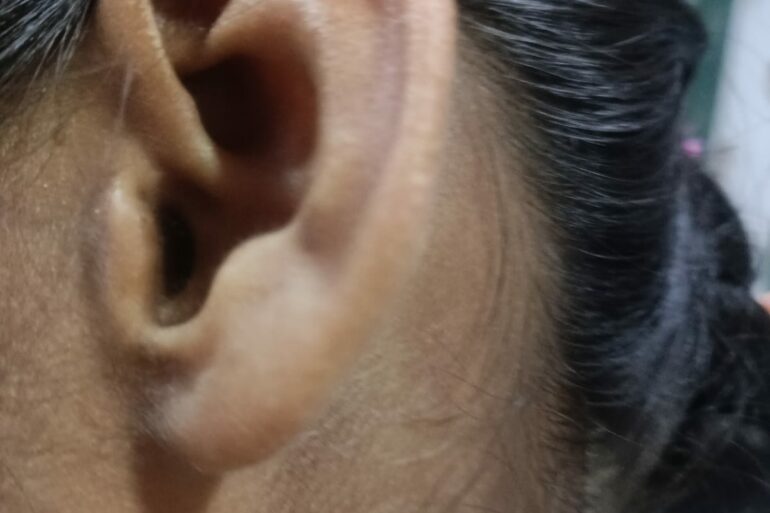 Flat warts for 4 years cured quickly with Homeopathy A case from Unnao