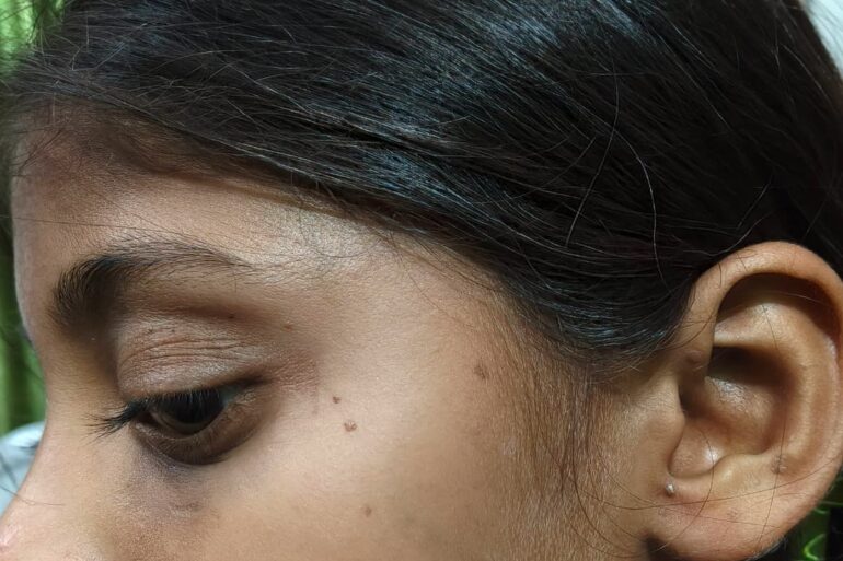 Flat warts for 4 years cured quickly with Homeopathy A case from Unnao