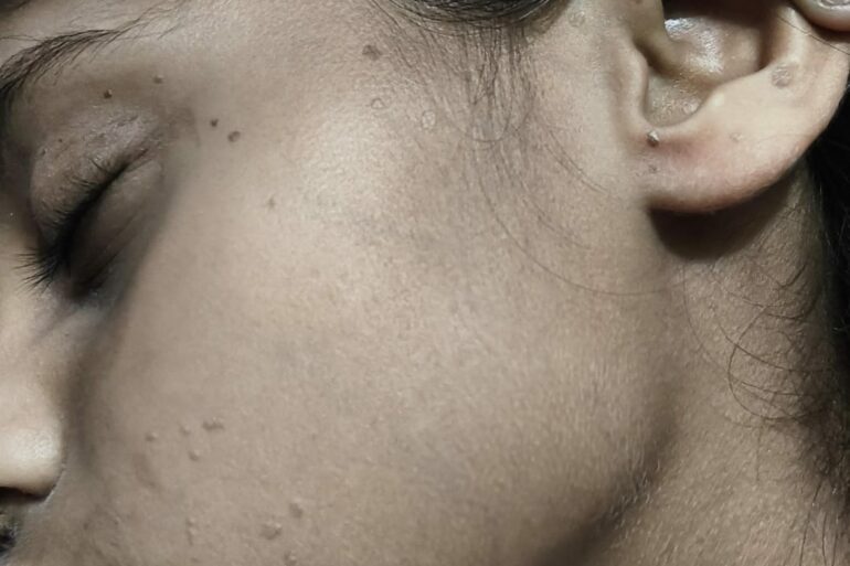 Flat warts for 4 years cured quickly with Homeopathy A case from Unnao