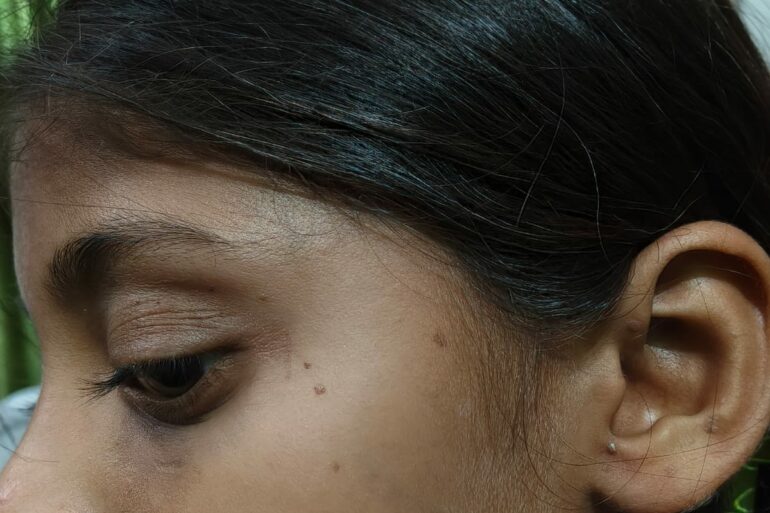 Flat warts for 4 years cured quickly with Homeopathy A case from Unnao