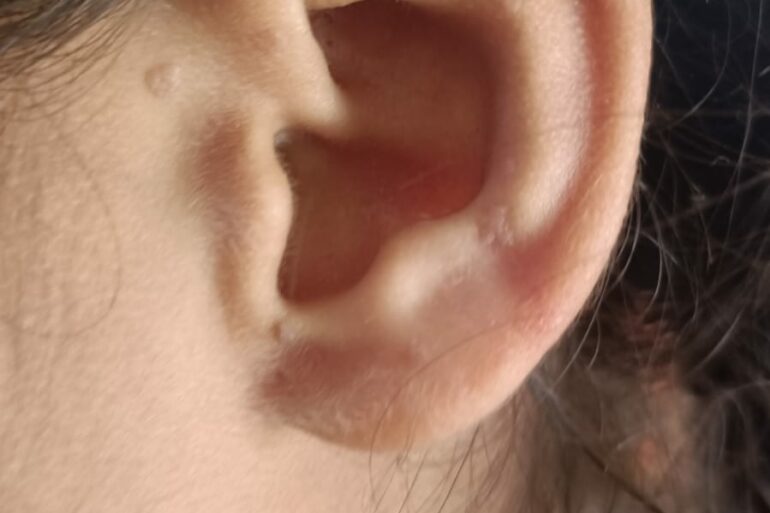 Flat warts for 4 years cured quickly with Homeopathy A case from Unnao