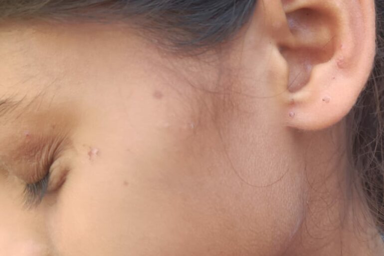 Flat warts for 4 years cured quickly with Homeopathy A case from Unnao