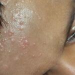 Flat warts for 4 years got cured in 12 days