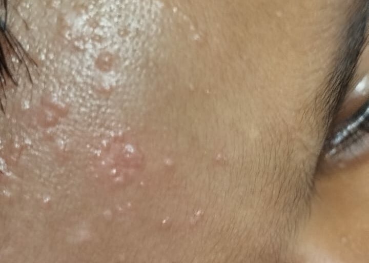 Flat warts for 4 years got cured in 12 days
