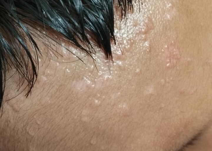Flat warts for 4 years got cured in 12 days