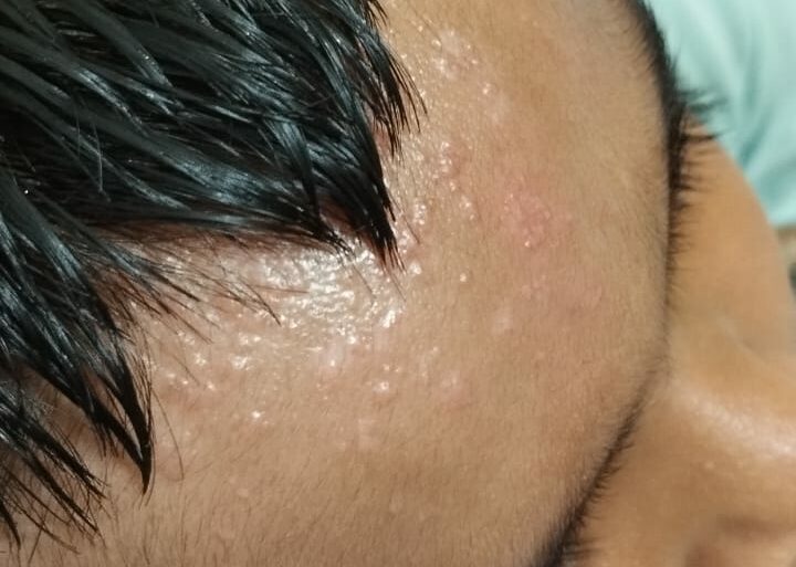 Flat warts for 4 years got cured in 12 days