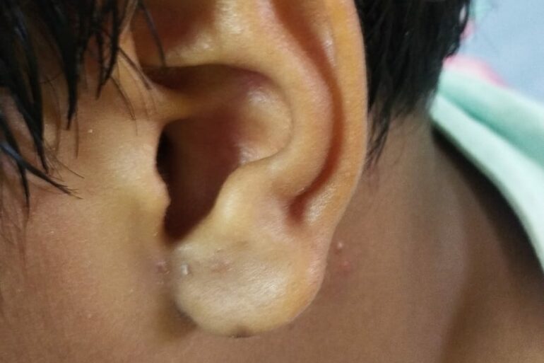 Flat warts for 4 years got cured in 12 days