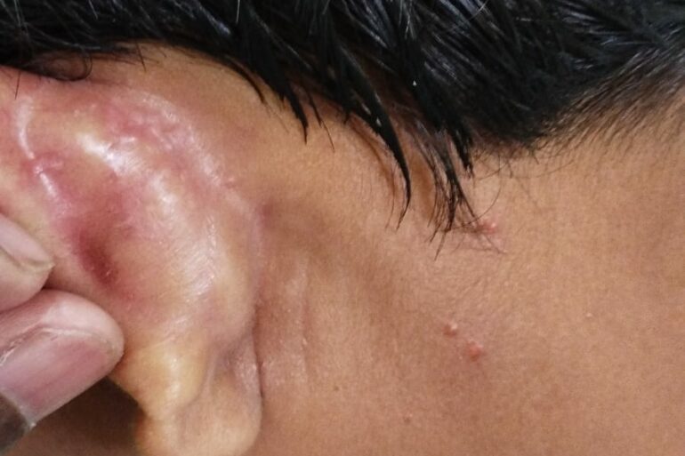Flat warts for 4 years got cured in 12 days