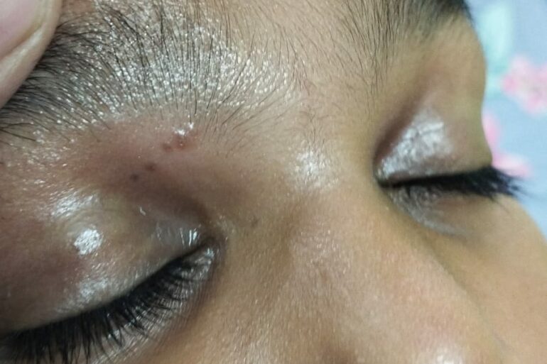 Flat warts for 4 years got cured in 12 days