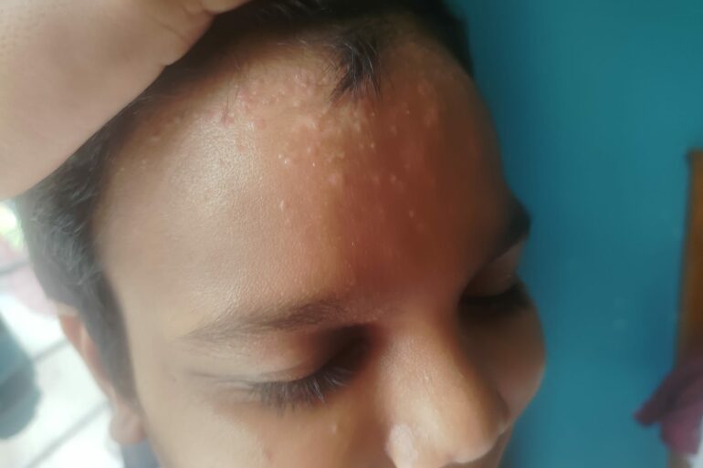 Flat warts for 4 years got cured in 12 days