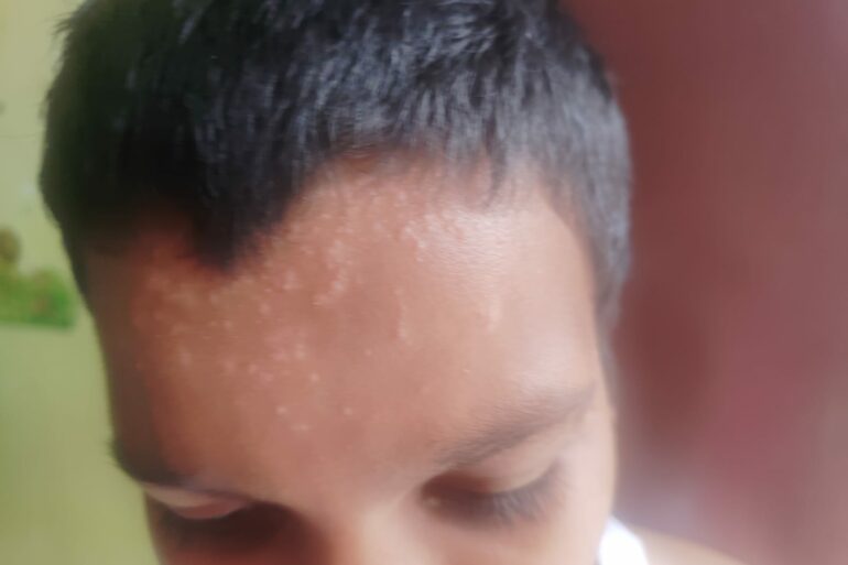Flat warts for 4 years got cured in 12 days