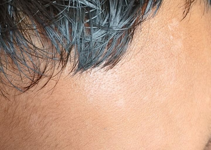 Flat warts for 4 years got cured in 12 days