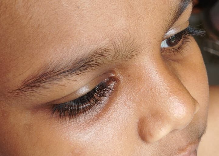 Flat warts for 4 years got cured in 12 days