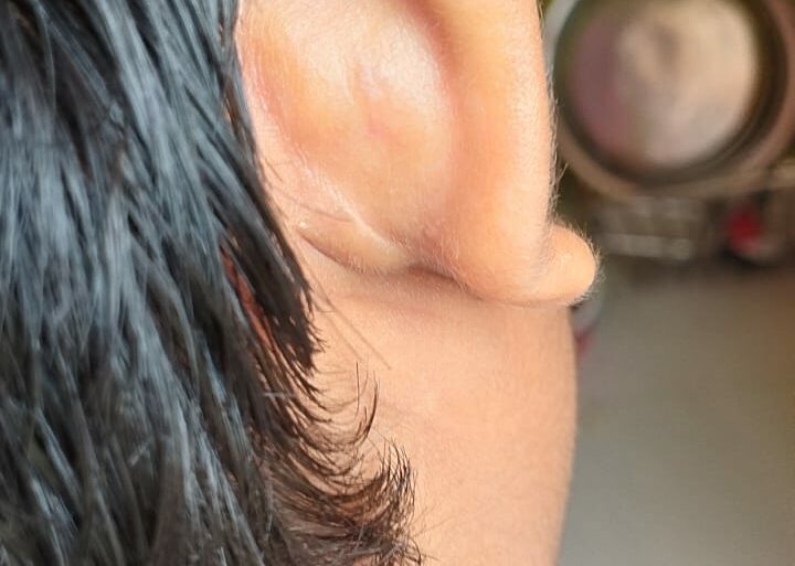 Flat warts for 4 years got cured in 12 days
