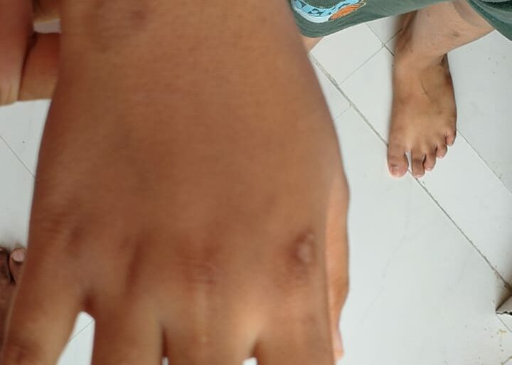 Flat warts for 4 years got cured in 12 days