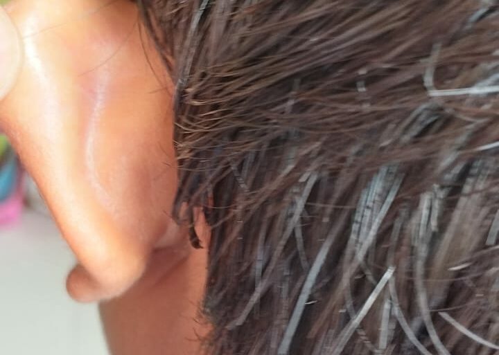 Flat warts for 4 years got cured in 12 days