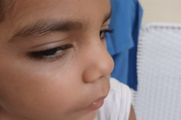 Facial Warts in a 5-Year-Old Child – Online Treatment from Bijnor