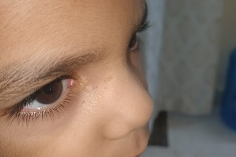 Facial Warts in a 5-Year-Old Child – Online Treatment from Bijnor
