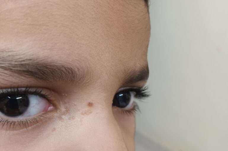 Facial Warts in a 5-Year-Old Child – Online Treatment from Bijnor