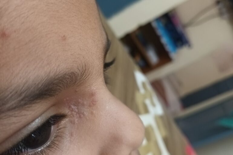Facial Warts in a 5-Year-Old Child – Online Treatment from Bijnor