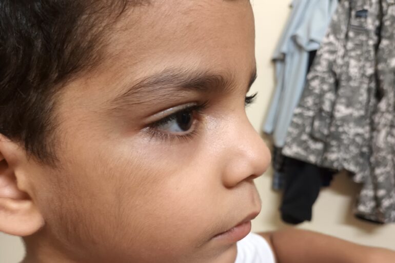 Facial Warts in a 5-Year-Old Child – Online Treatment from Bijnor