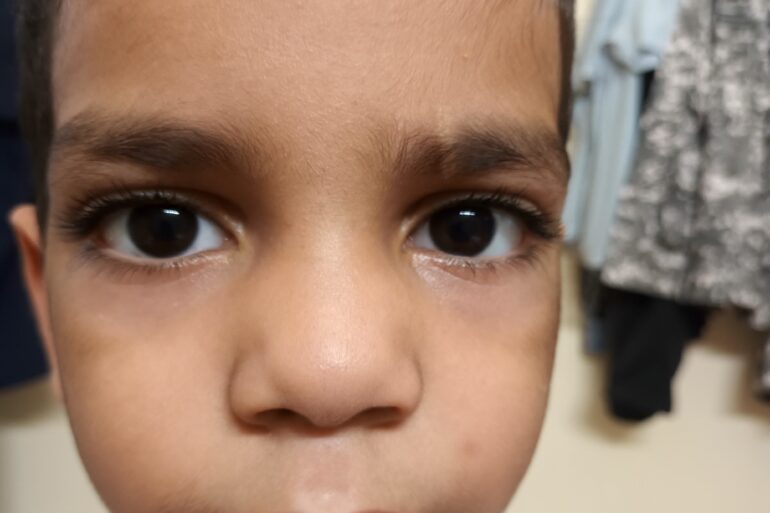 Facial Warts in a 5-Year-Old Child – Online Treatment from Bijnor