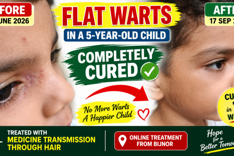 Facial Warts in a 5-Year-Old Child – Online Treatment from Bijnor