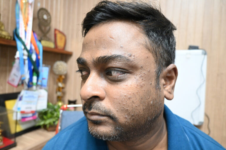 WARTS SINCE 2017 GETTING BETTER IN 21 DAYS- AMZING RECOVERY