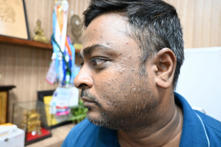 WARTS SINCE 2017 GETTING BETTER IN 21 DAYS- AMZING RECOVERY