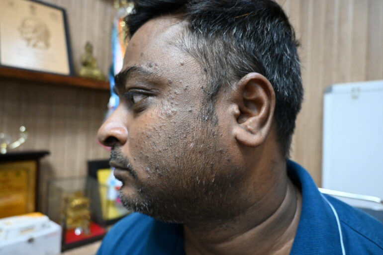 WARTS SINCE 2017 GETTING BETTER IN 21 DAYS- AMZING RECOVERY