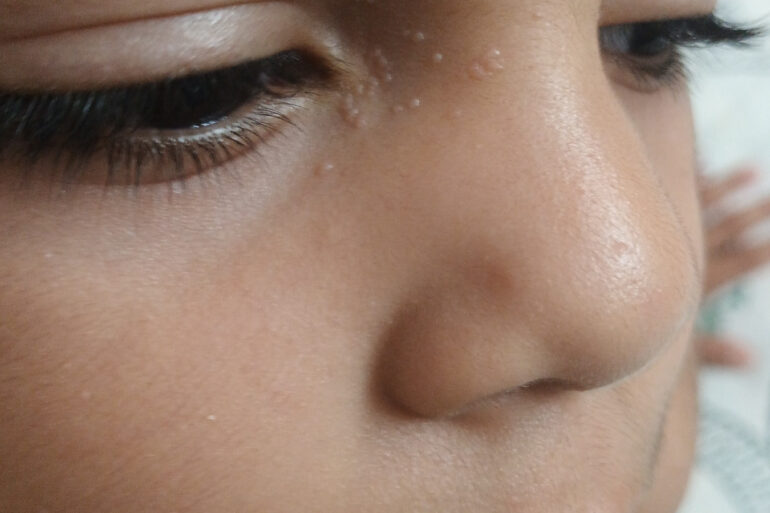 Facial Warts in a 5-Year-Old Child – Online Treatment from Bijnor