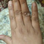 Warts for more than 3 years got cured