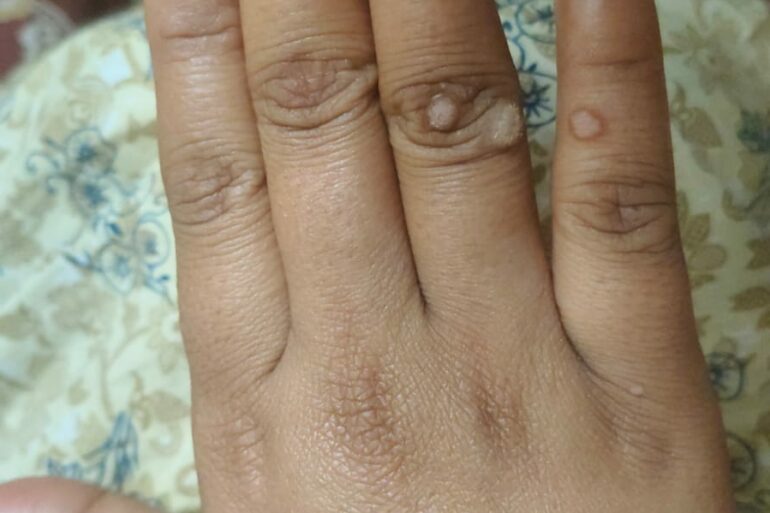 Warts for more than 3 years got cured