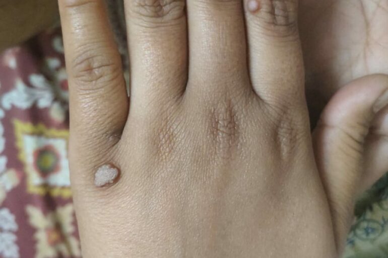 Warts for more than 3 years got cured