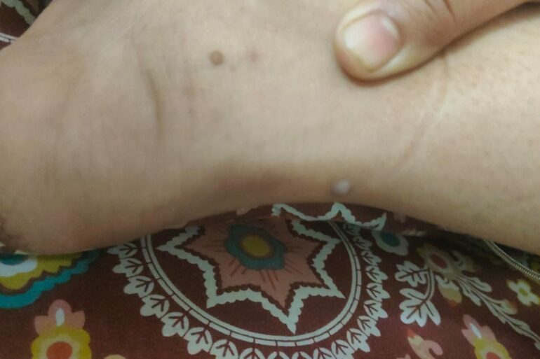 Warts for more than 3 years got cured