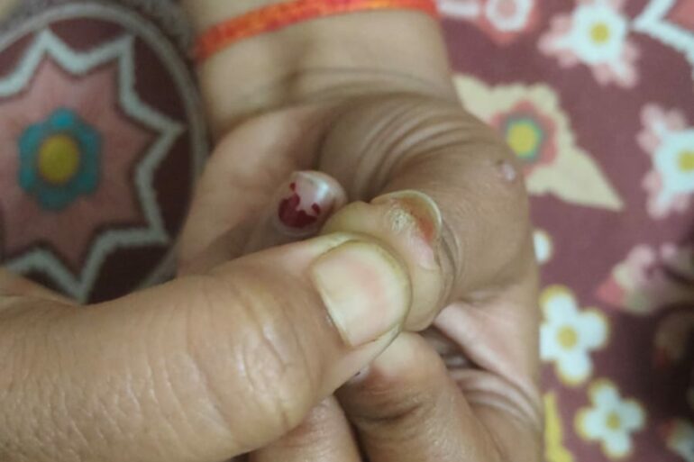Warts for more than 3 years got cured