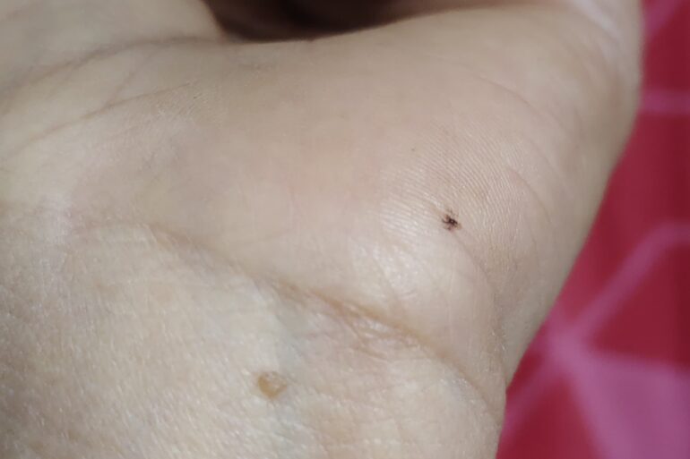 Warts for more than 3 years got cured