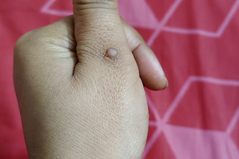 Warts for more than 3 years got cured
