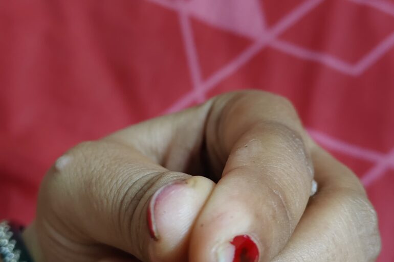 Warts for more than 3 years got cured