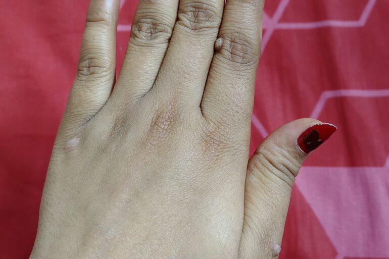 Warts for more than 3 years got cured