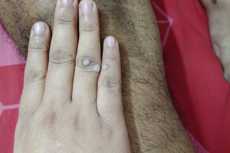 Warts for more than 3 years got cured