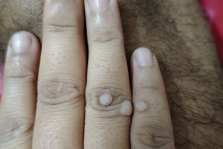 Warts for more than 3 years got cured