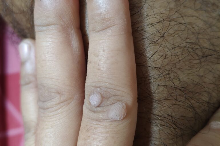 Warts for more than 3 years got cured