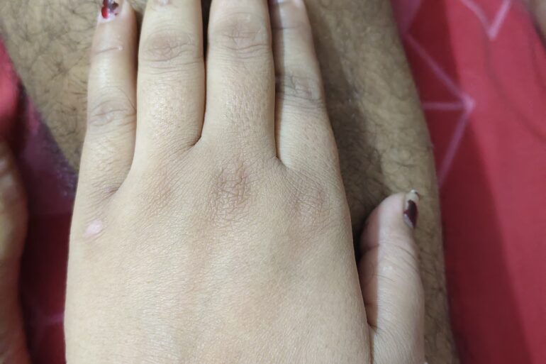 Warts for more than 3 years got cured