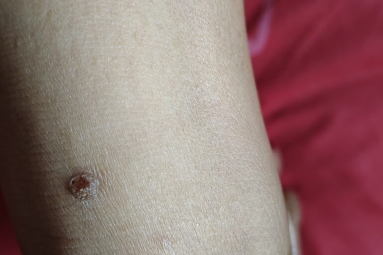 Warts for more than 3 years got cured